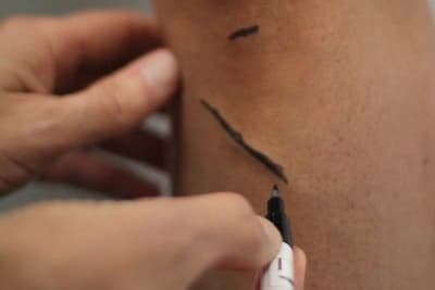 Forberedelse til åreknutebehandling