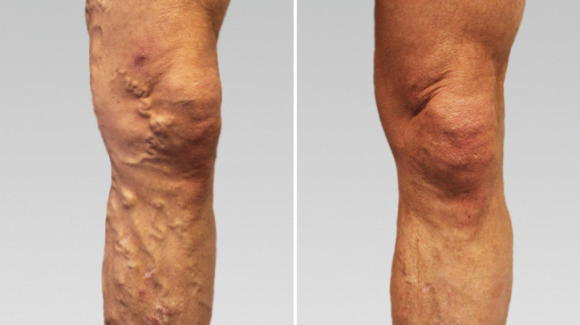 Før og etter resultat av åreknutebehandling