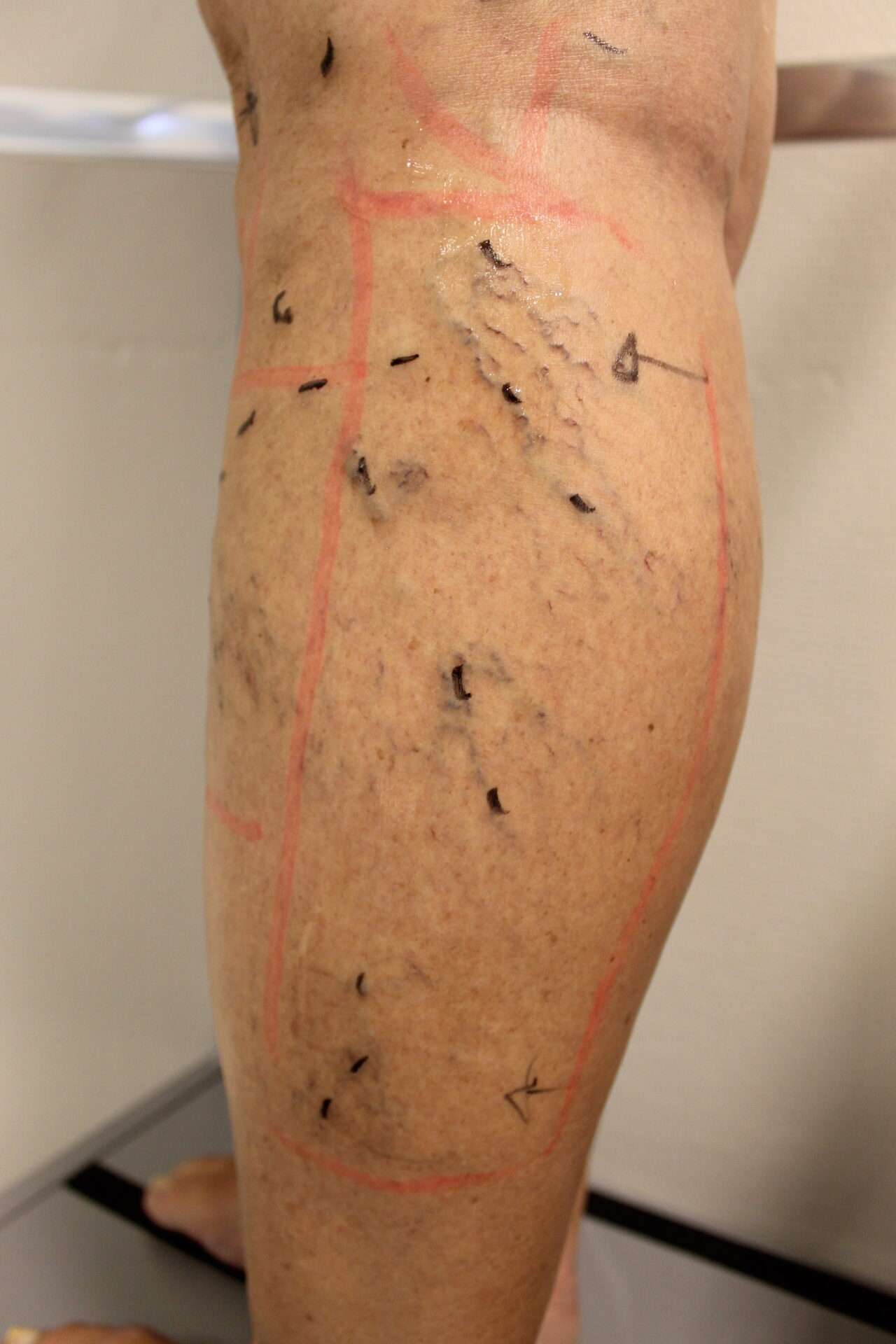 Markering før sklerosering av sprengte blodkar