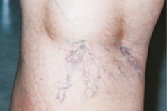 CEAP grad 1: Sprengte blodkar (årenett)