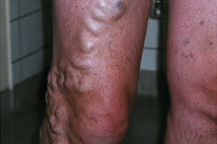 CEAP grad 2: Åreknuter (varicer)