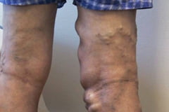 CEAP grad 3: Åreknuter med kronisk ødem