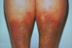 CEAP grad 4: Åreknuter med hudforandringer