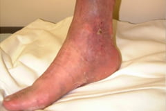 CEAP grad 5: Åreknuter med tilhelet leggsår