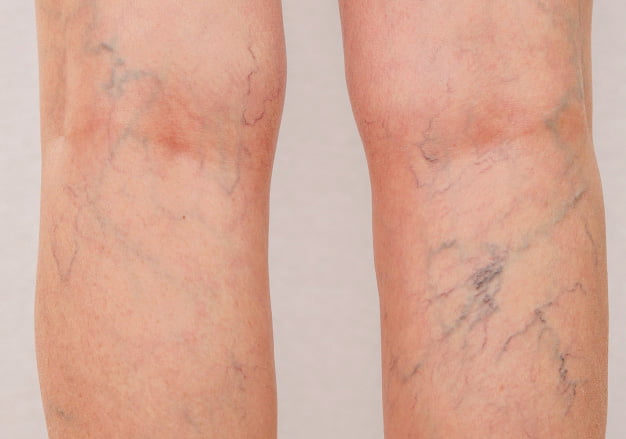 Sprengte blodkar på ben