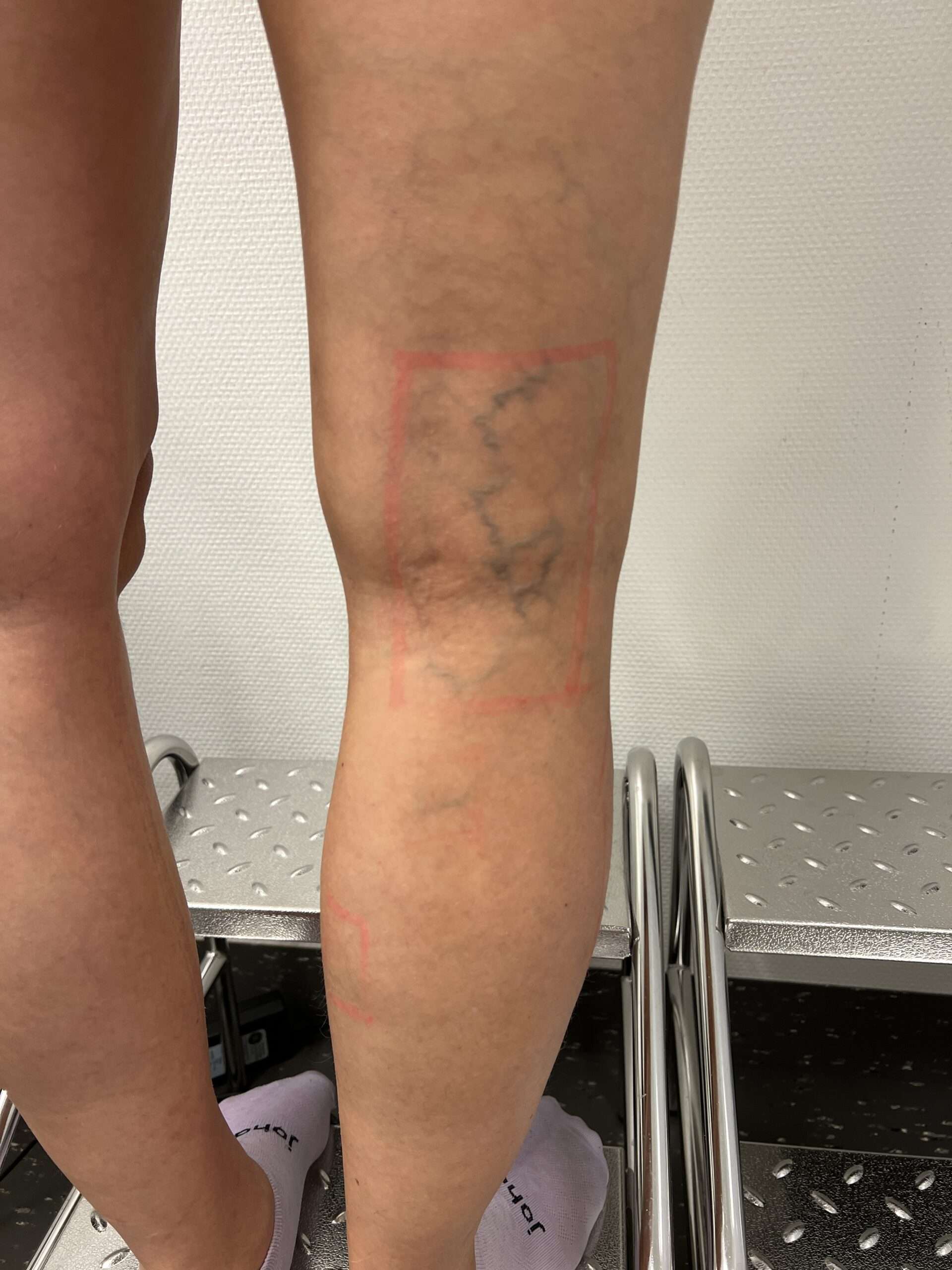 Sprengte blodkar på legg